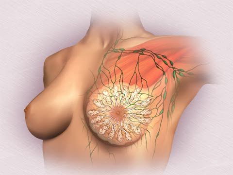 Фіброзно-кістозна мастопатія: симптоми, лікування