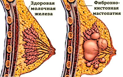 Фіброзно-кістозна мастопатія: симптоми, лікування