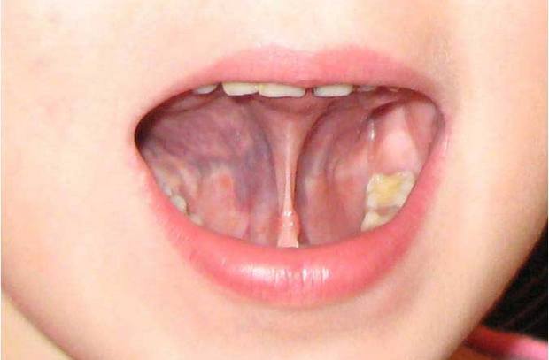 Чи потрібно підрізати коротку вуздечку язика дитині Чи потрібно підрізати коротку вуздечку язика дитині